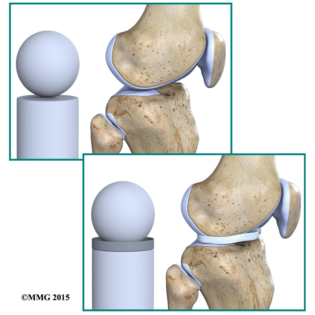 Meniscus - Gasket