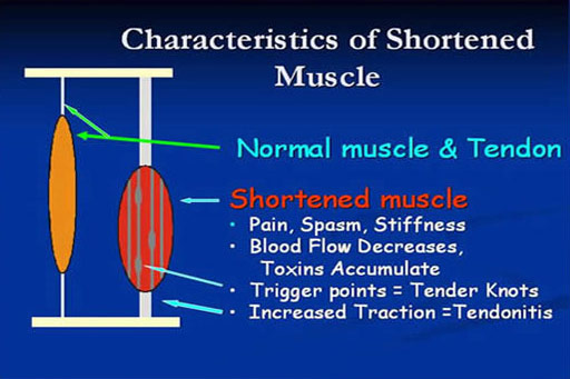 Acupuncture
